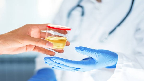 Ilustrasi sampel urine yang menunjukkan potensi penggunaan cfDNA untuk mendeteksi kanker kandung kemih secara noninvasif.